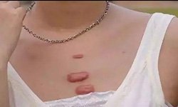 疤痕疙瘩