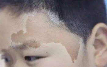 咖啡斑样子